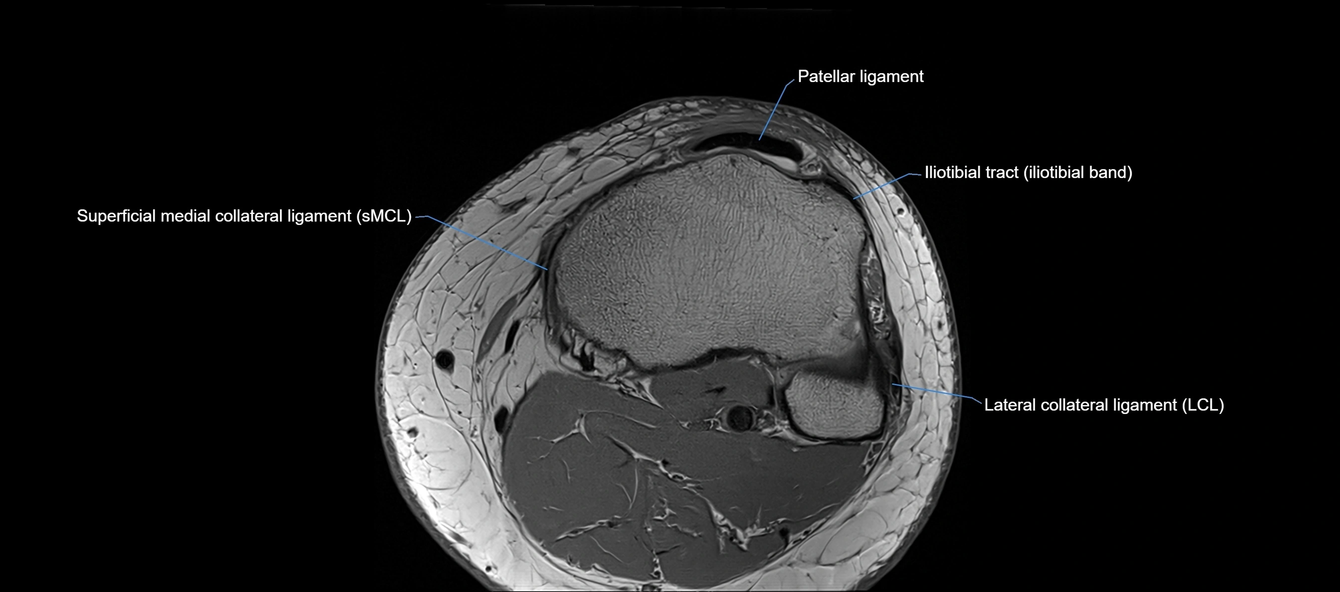 MRI Knee axial  ligaments cross sectional anatomy 3T  radiology  image-img-03001-00040.webp